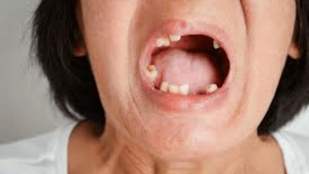 El mensaje oculto de los sue�os con ca�da de dientes: qu� dice la psicolog�a sobre su verdadero significado