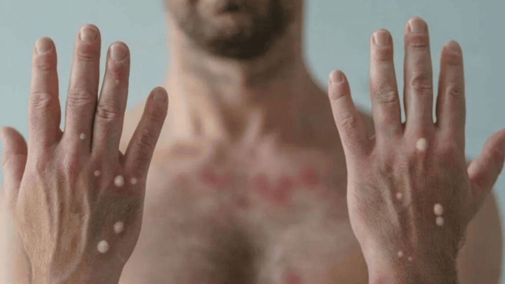Contagio local confirmado: preocupación en Mendoza por la viruela del mono