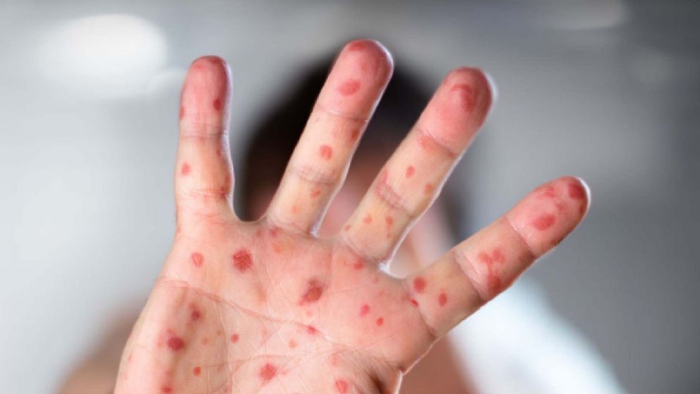 Conocé cuál es el nuevo calendario de vacución contra el sarampión