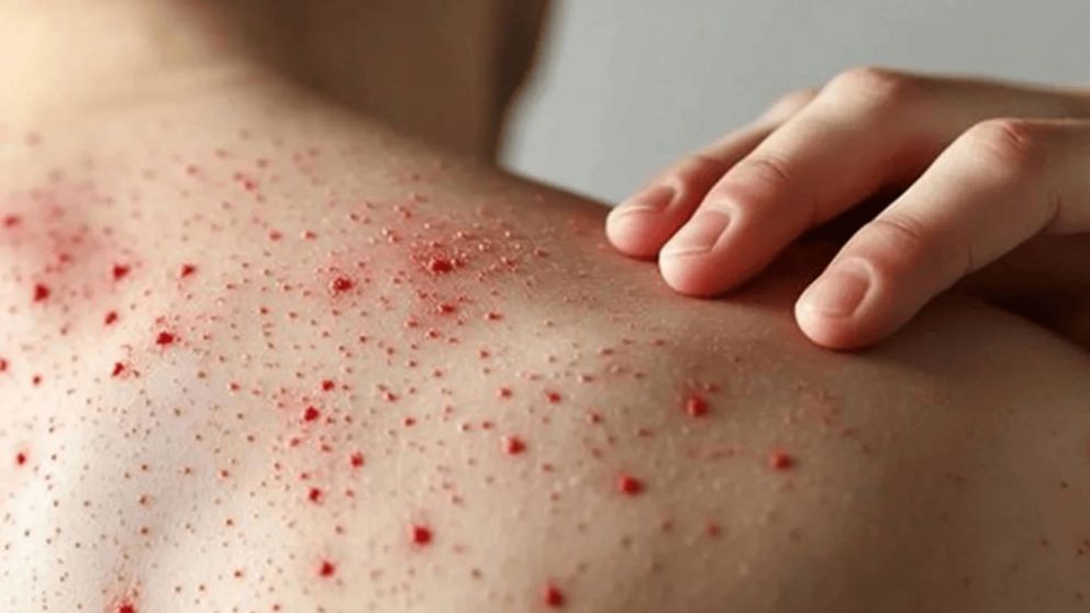 El Ministerio de Salud comenzó a distribuir la vacuna contra el sarampión: dónde vacunarse en el AMBA