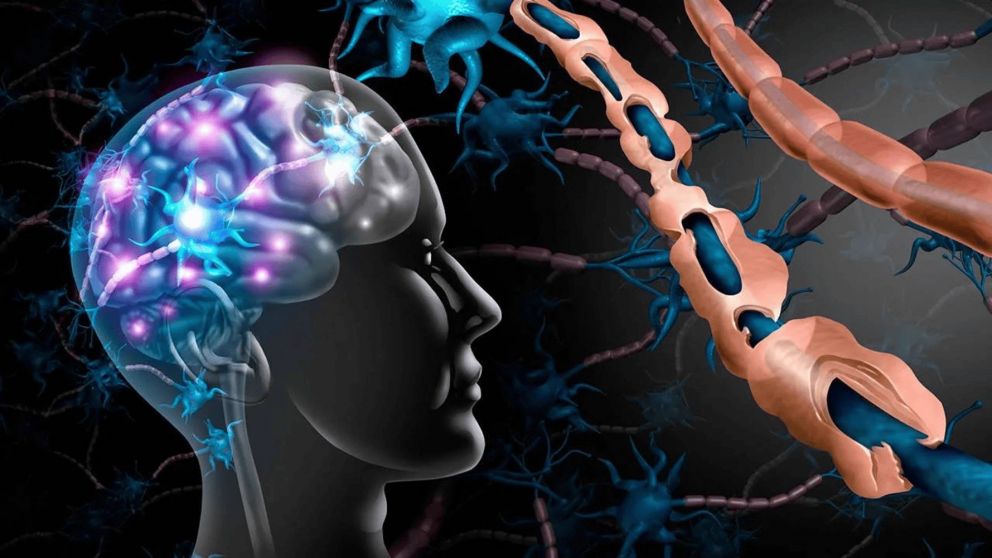 Un tratamiento novedoso que trae esperanza contra la esclerosis m�ltiple.