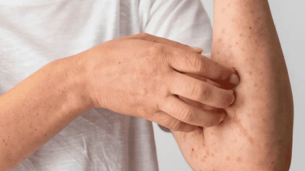 Alerta por el sarampión