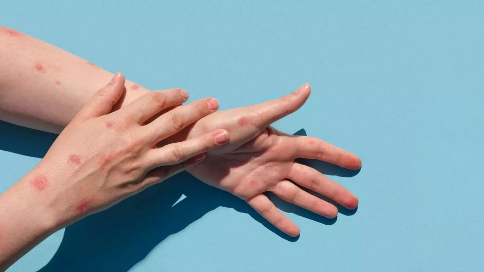 Mpox: cómo se contagia, cuáles son sus síntomas. Toda la información que necesitás saber, a detalle