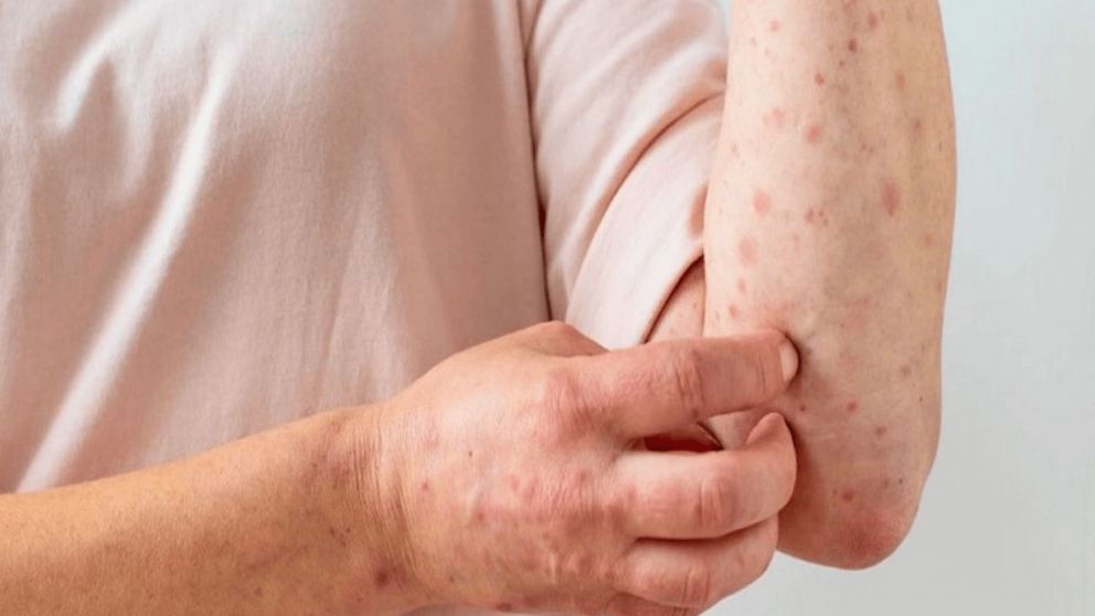 El boletín epidemiológico semanal indicó que los 7 nuevos casos de personas con viruela del mono son de la zona Centro del país (Imagen ilustrativa).