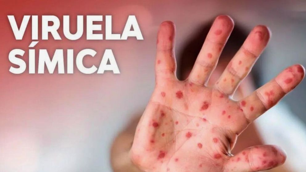 Mirá cómo se contagia y cuáles son los síntomas de la viruela del mono