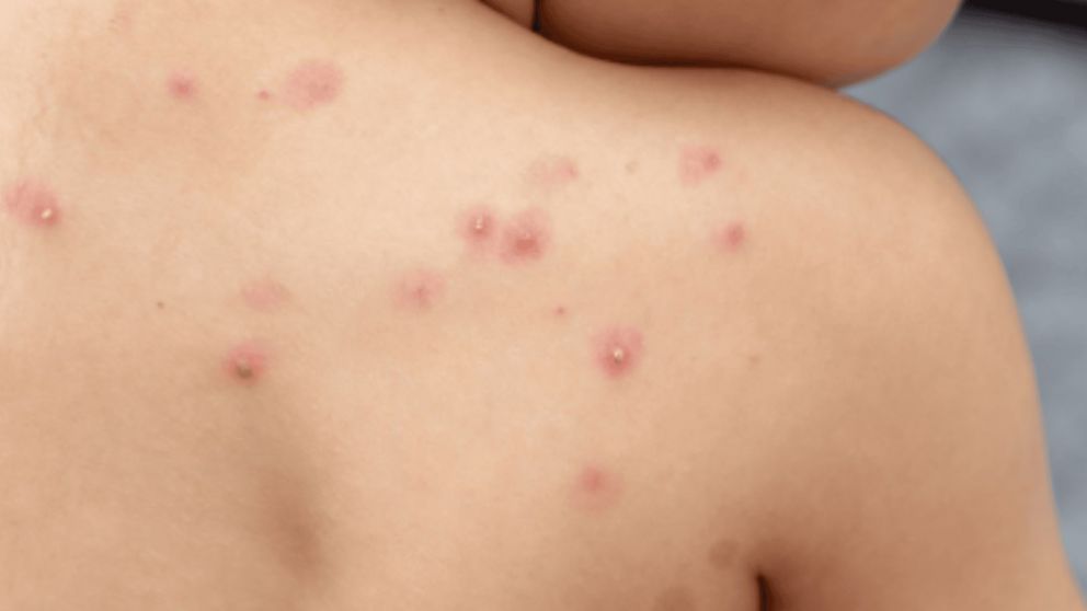 El panorama del brote epidemiológico de viruela del mono