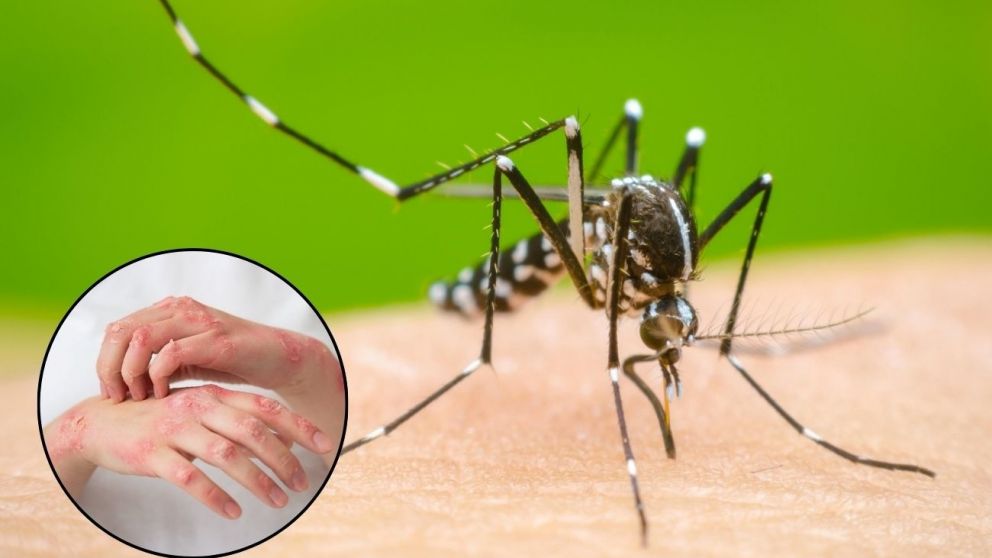 Conocé todos los detalles sobre el dengue