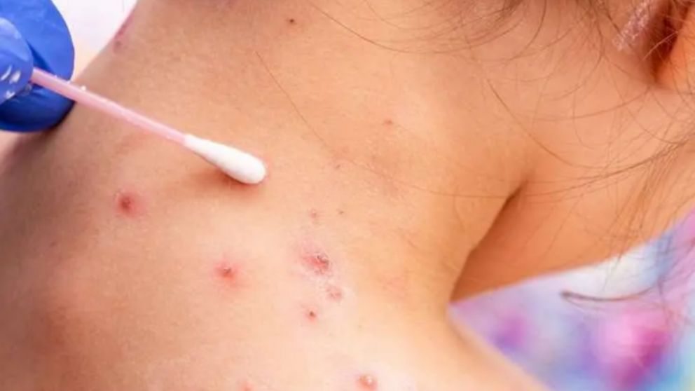 Cómo prevenir el contagio