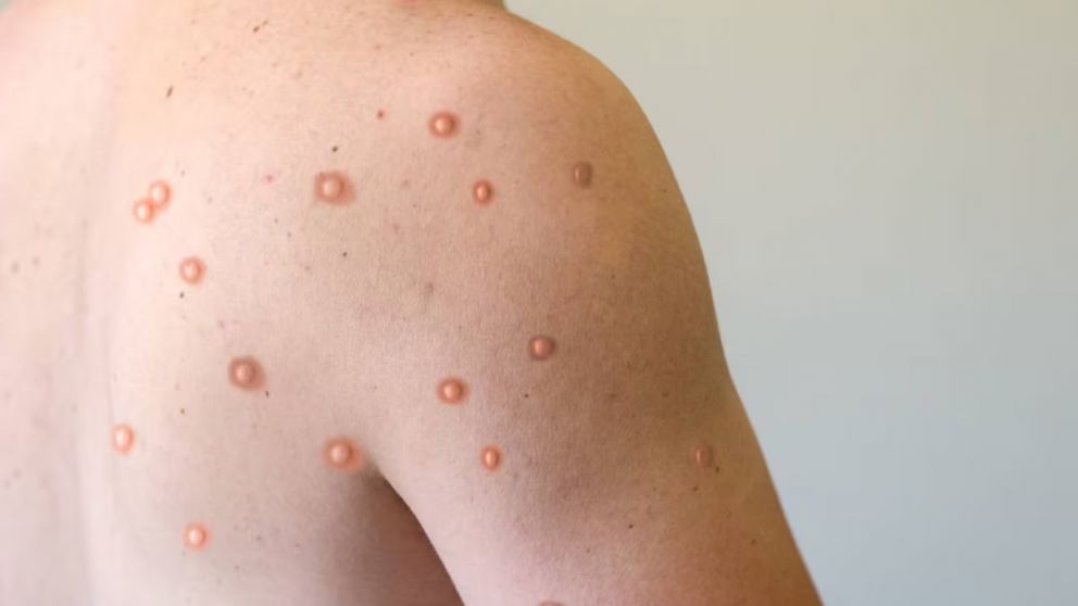 Ya hay dos variantes de vacuna contra el mpox