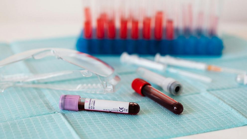 Científicos de la UCLA desarrollaron MethylScan, un test de sangre que detecta distintos tipos de cáncer y enfermedades hepáticas con alta precisión