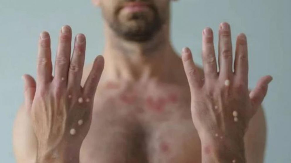 Detectan el primer caso de contagio de covid-19, viruela de mono y VIH