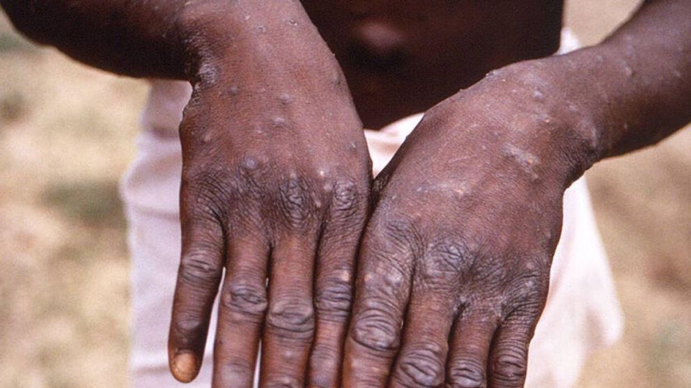 En la Argentina se confirmaron 13 casos