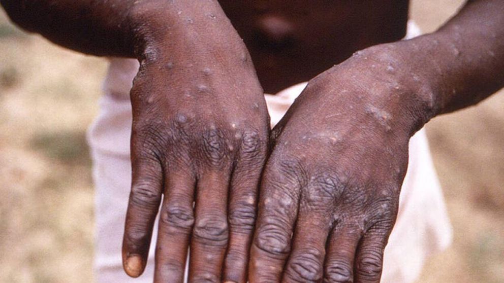 La viruela de mono tiene 13 casos confirmados en Argentina