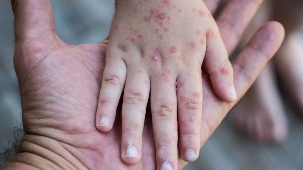 La OMS alerta sobre brote de sarampi�n en el mundo 
