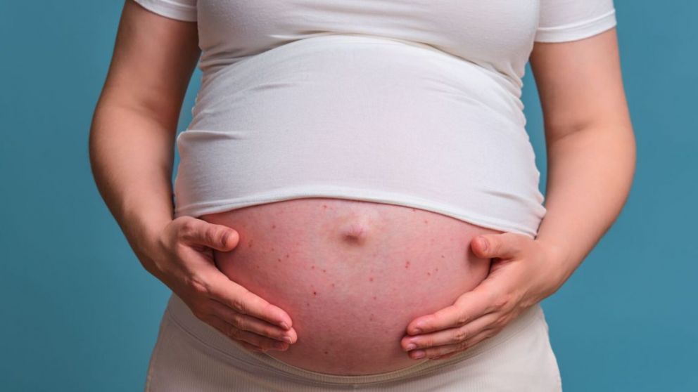 Sarampión en Argentina: detectaron el contagio en una embarazada