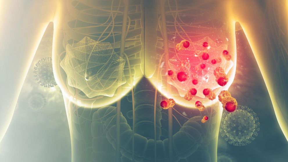 Argentina ocupa el segundo lugar en riesgo de muerte por cáncer de mama en América Latina