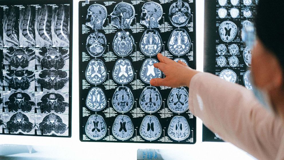 Coronavirus; científicos advirtieron por otras las graves consecuencias neurológicas