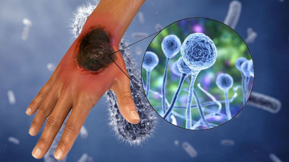 Primer muerte por hongo negro en Argentina