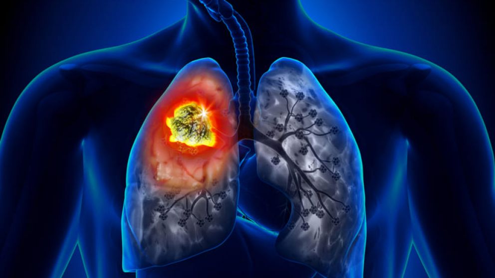 Nuevos avances relacionados al cáncer de pulmón
