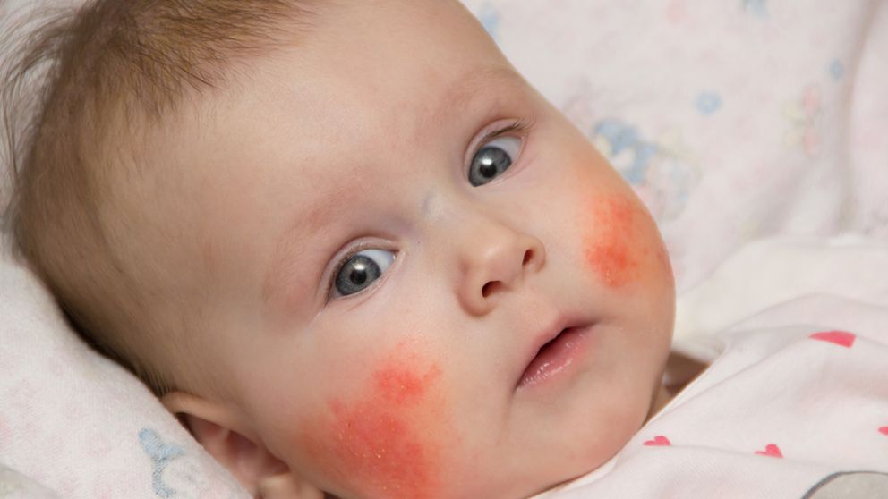 La enfermedad fue incluido como una posible complicaci�n del coronavirus