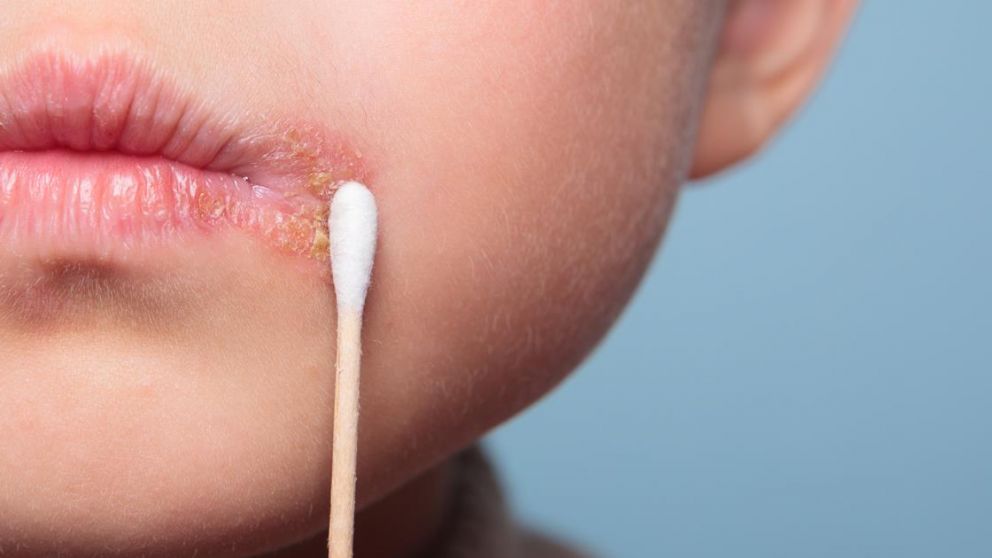 La OMS advierte sobre la gran cantidad de contagios de herpes oral