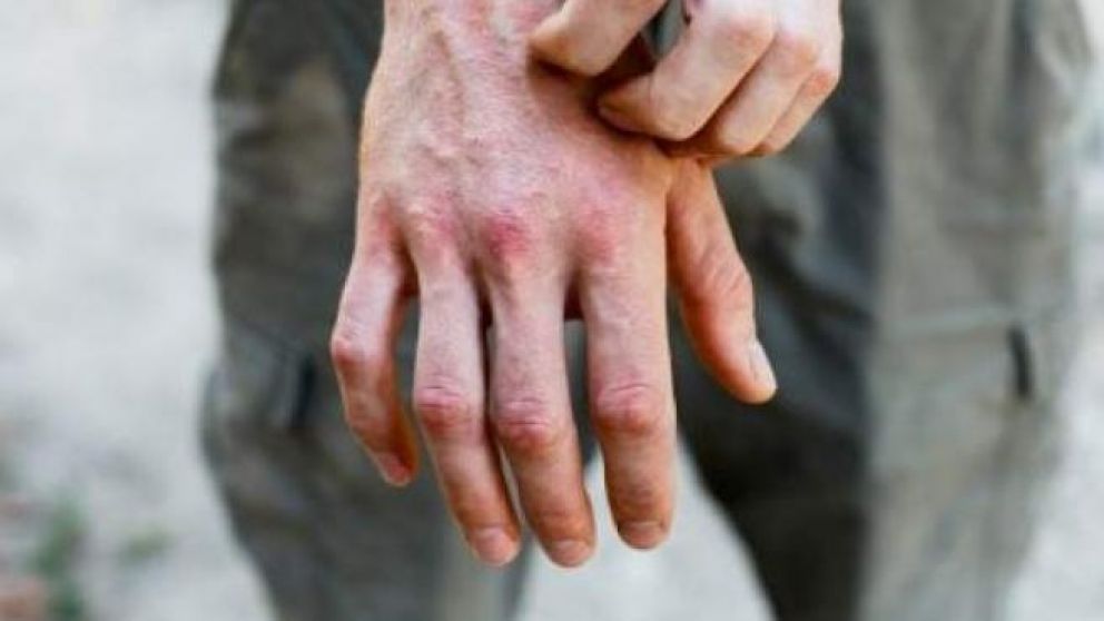 Las cinco manifestaciones en la piel por coronavirus según la edad