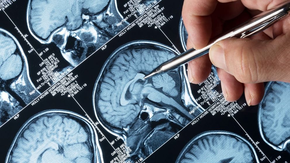 Una enfermedad muchas veces subdiagnosticada