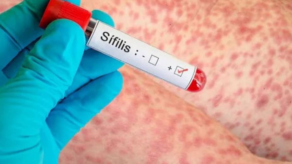 Casos de sífilis en Argentina: síntomas, detección y prevención